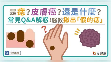 痣為什麼會長毛|是痣？皮膚癌？還是什麼？常見Q&A解惑！醫教揪出「。